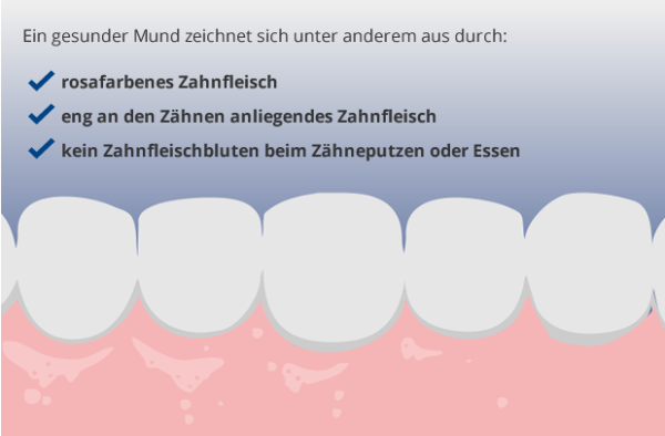 Hinweise Auf Zahnfleischerkrankungen - Chlorhexamed